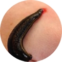 leech therapy, sri sri ayurveda hospital